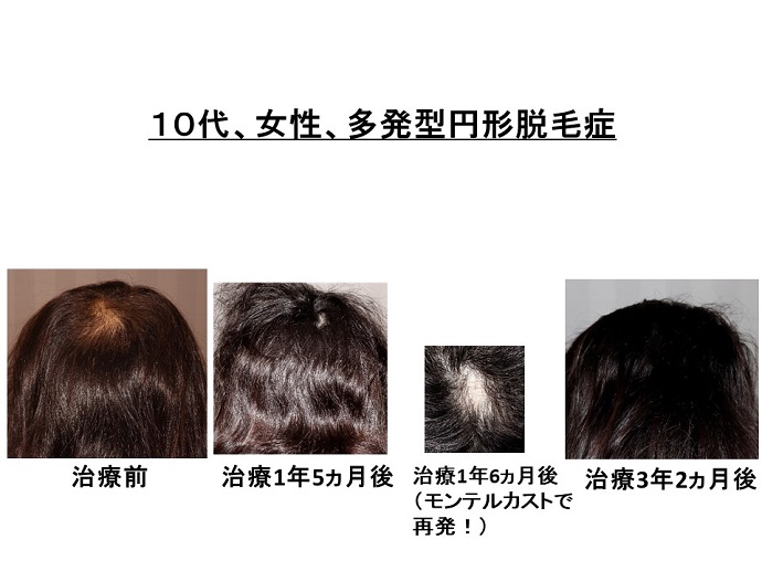円形脱毛症　病院
